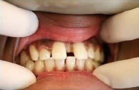 Before Image: Invisalign - front