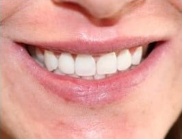 After Image: Smile Design - front