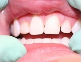 Before Image: Smile Design