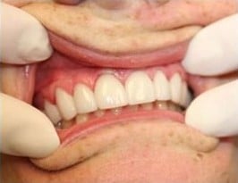 After Image: Veneer - front