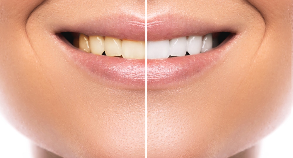 Close up of a smiling woman's mouth showing how much whiter her teeth are after Zoom Whitening treatment.