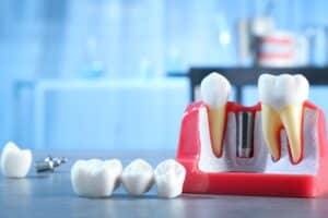 Close up of some models of dental crowns and dental bridges